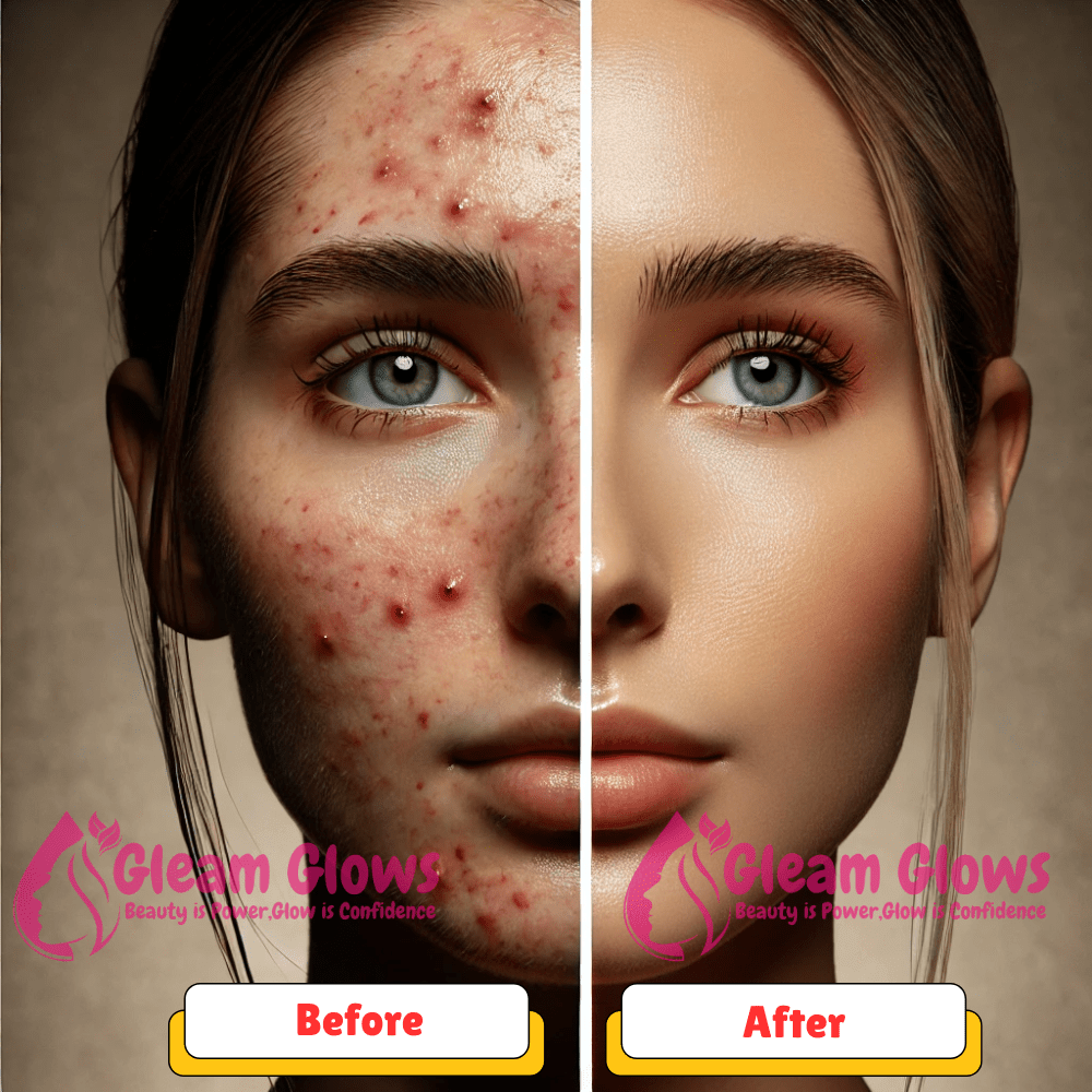 Your Solution to Everyday Skin Concerns With Biore Acne care 130g Face Wash