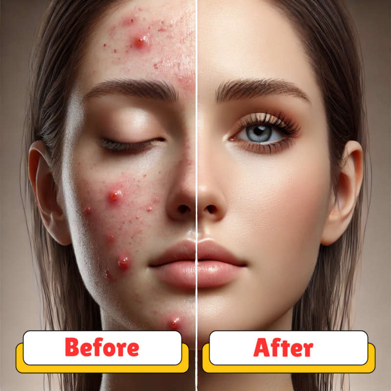 Before & After Effects with Annazarube Ace Acne treatment Cream